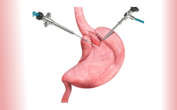 Laparoscopic Anti-Reflux Surgery